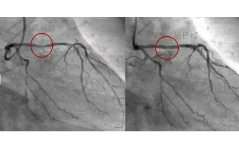 深圳市模具厂对心脏支架的关注，国产化的道路有多长？
